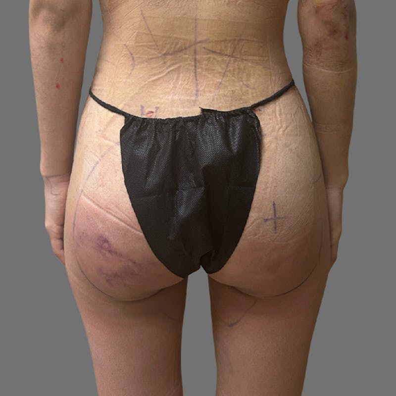 Brazilian Butt Lift Before & After Gallery - Patient 381026 - Image 2