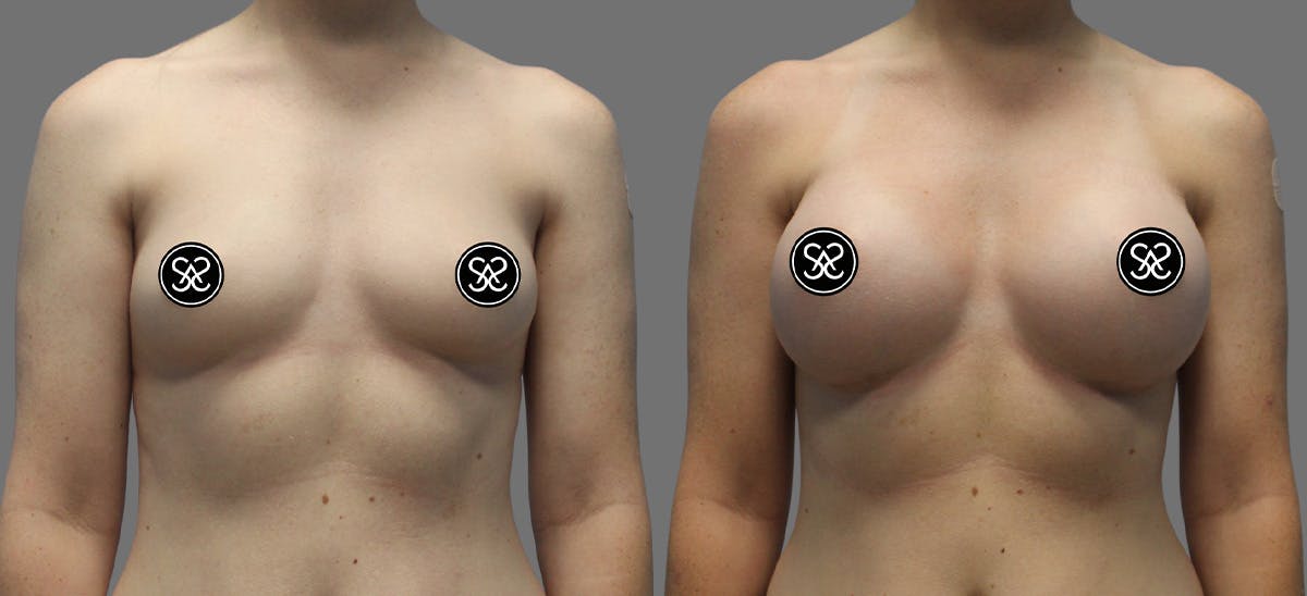 Breast Augmentation Before & After Gallery - Patient 175929 - Image 1