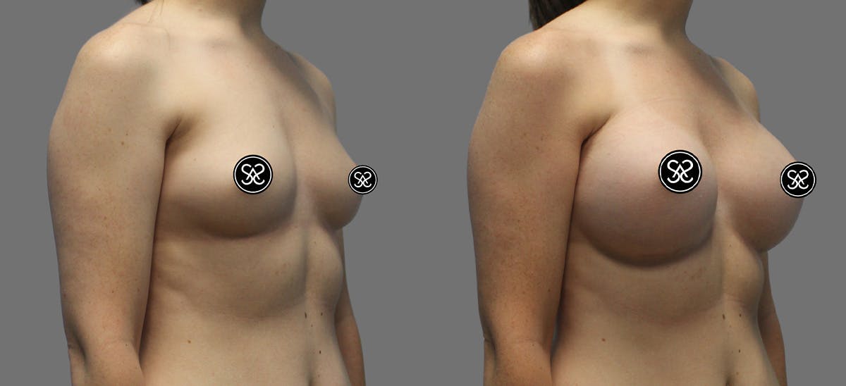 Breast Augmentation Before & After Gallery - Patient 175929 - Image 2