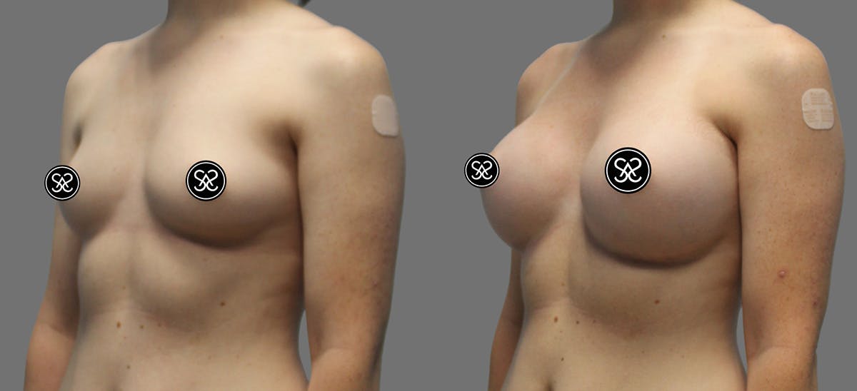 Breast Augmentation Before & After Gallery - Patient 175929 - Image 3