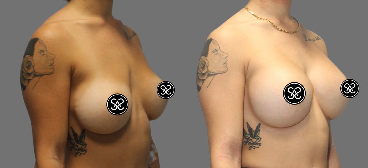 Breast Augmentation Before & After Gallery - Patient 367571 - Image 2