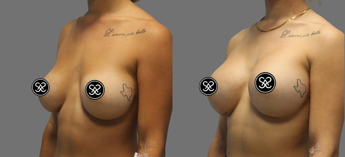 Breast Augmentation Before & After Gallery - Patient 367571 - Image 3