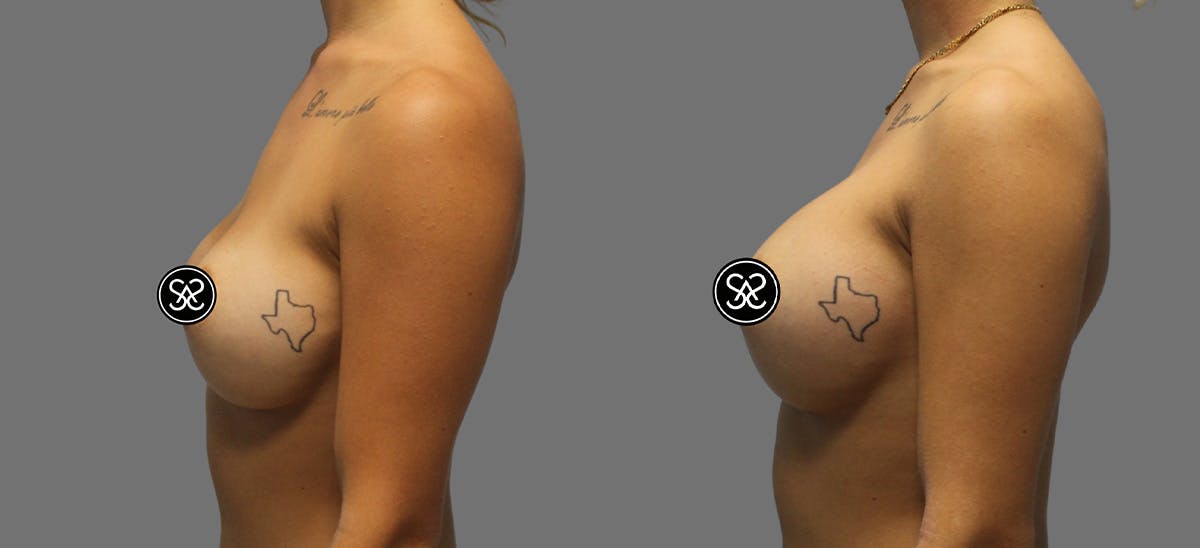 Breast Augmentation Before & After Gallery - Patient 367571 - Image 4