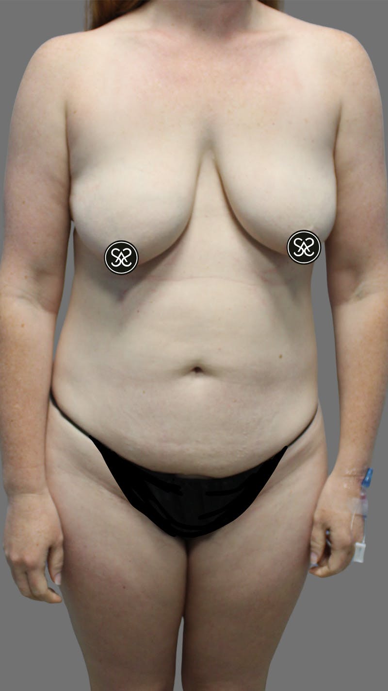 High Definition Mommy Makeover Before & After Gallery - Patient 272088 - Image 1