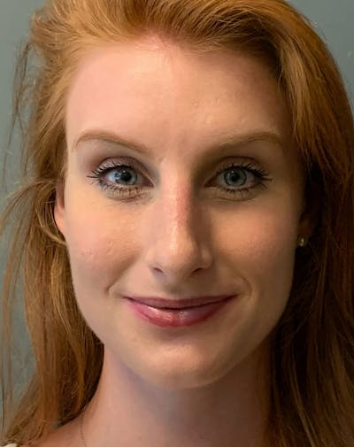 Rhinoplasty Before & After Gallery - Patient 186794 - Image 2