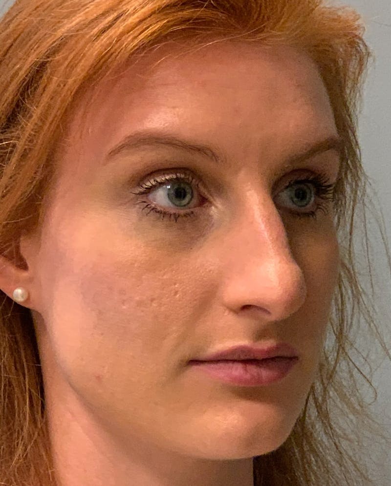 Rhinoplasty Before & After Gallery - Patient 186794 - Image 3