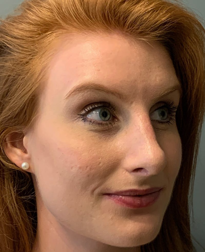 Rhinoplasty Before & After Gallery - Patient 186794 - Image 4