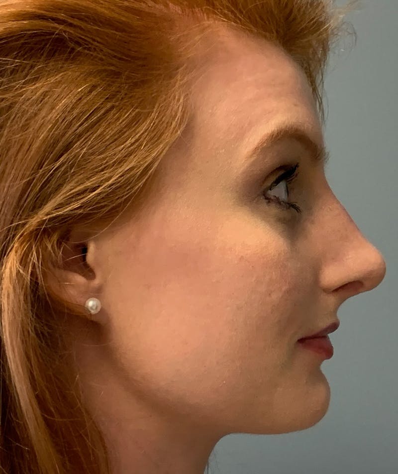 Rhinoplasty Before & After Gallery - Patient 186794 - Image 6