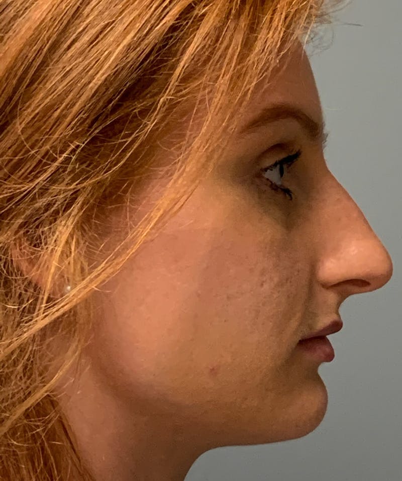 Rhinoplasty Before & After Gallery - Patient 186794 - Image 5