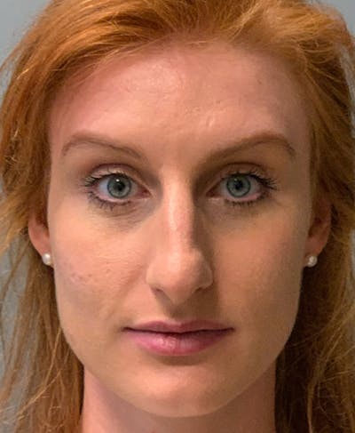 Rhinoplasty Before & After Gallery - Patient 186794 - Image 1