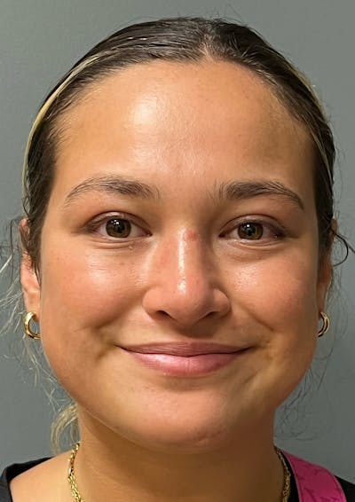 Rhinoplasty Before & After Gallery - Patient 278504 - Image 2