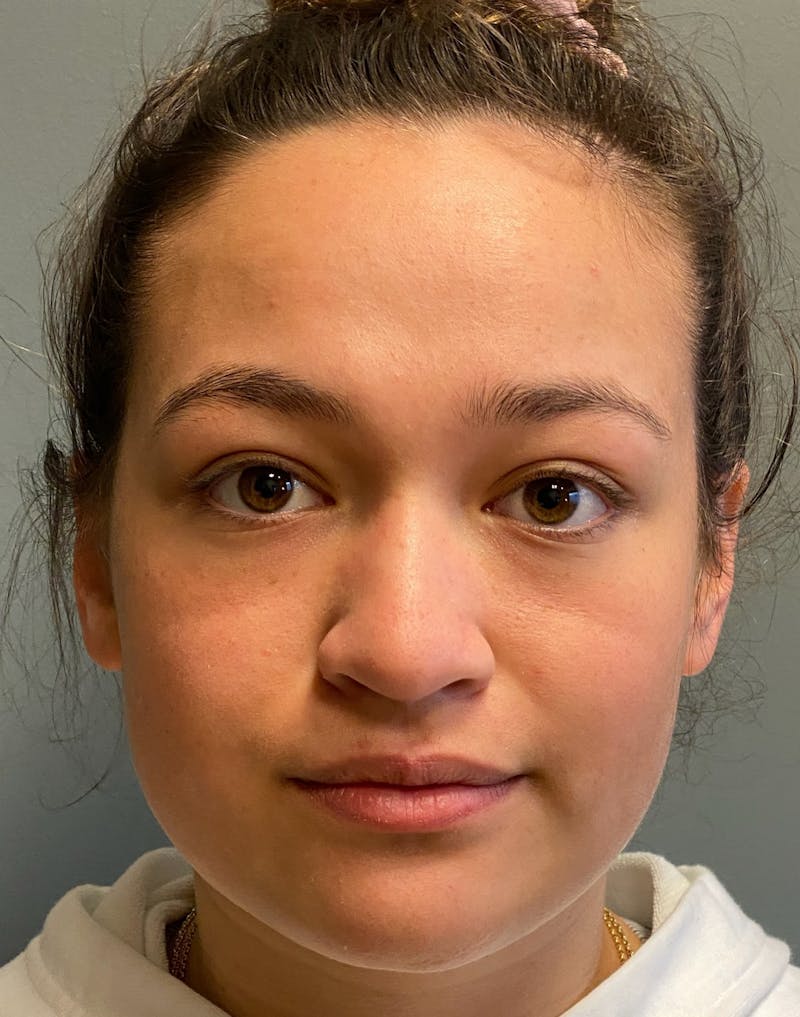 Rhinoplasty Before & After Gallery - Patient 278504 - Image 1