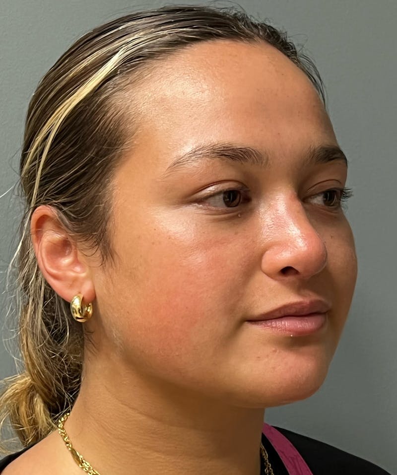 Rhinoplasty Before & After Gallery - Patient 278504 - Image 4