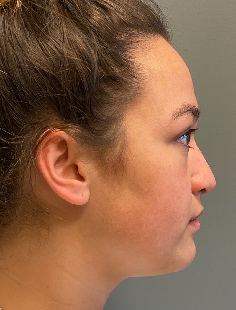 Rhinoplasty Before & After Gallery - Patient 278504 - Image 5