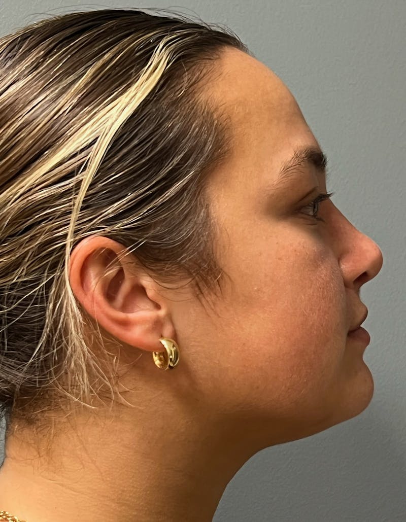 Rhinoplasty Before & After Gallery - Patient 278504 - Image 6
