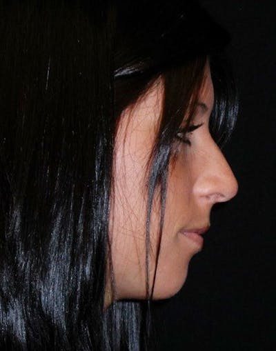 Rhinoplasty Before & After Gallery - Patient 100682 - Image 1