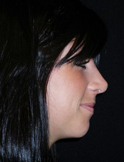 Rhinoplasty Before & After Gallery - Patient 100682 - Image 2