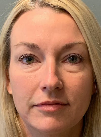 Blepharoplasty Before & After Gallery - Patient 387357 - Image 1