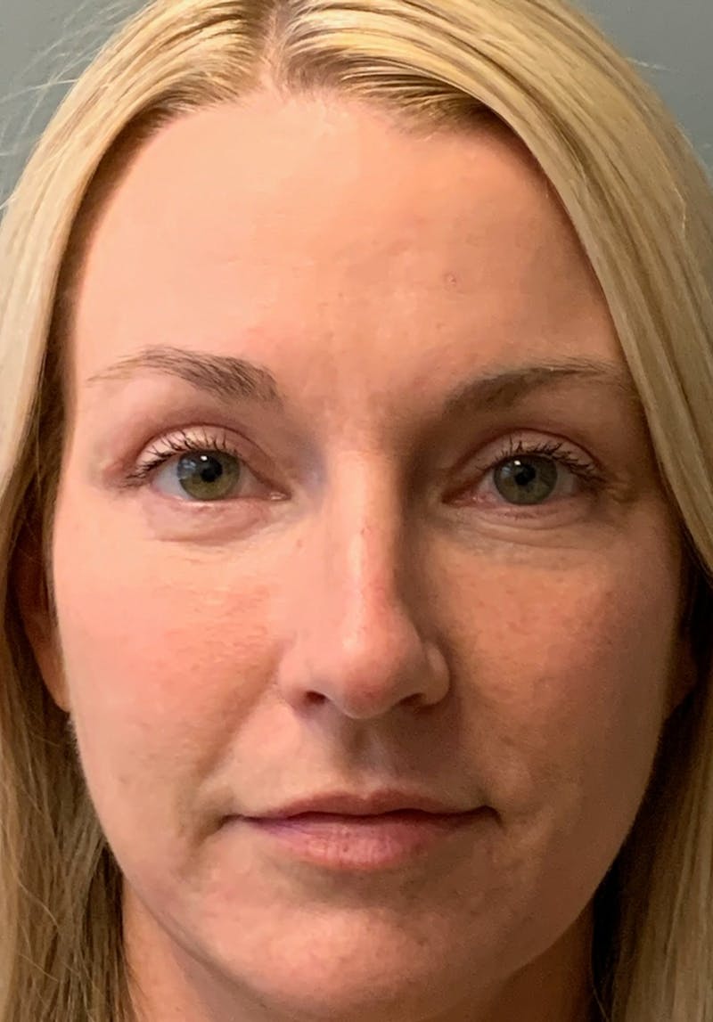 Blepharoplasty Before & After Gallery - Patient 387357 - Image 2