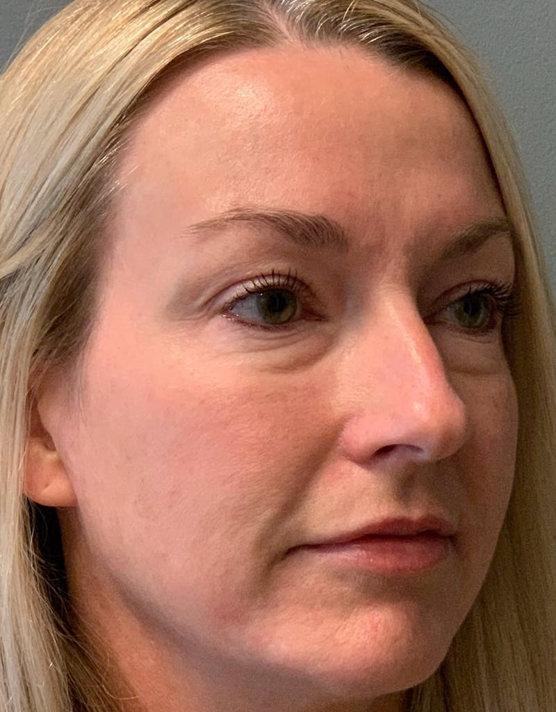 Blepharoplasty Before & After Gallery - Patient 387357 - Image 3