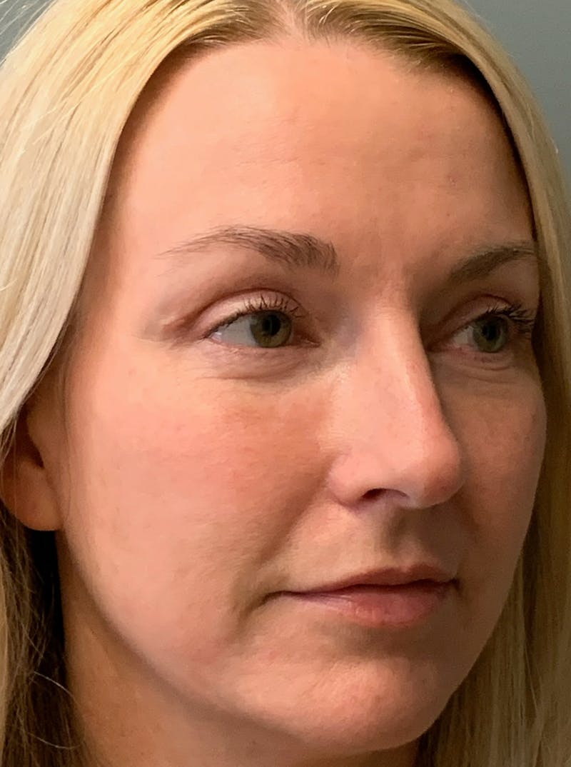 Blepharoplasty Before & After Gallery - Patient 387357 - Image 4