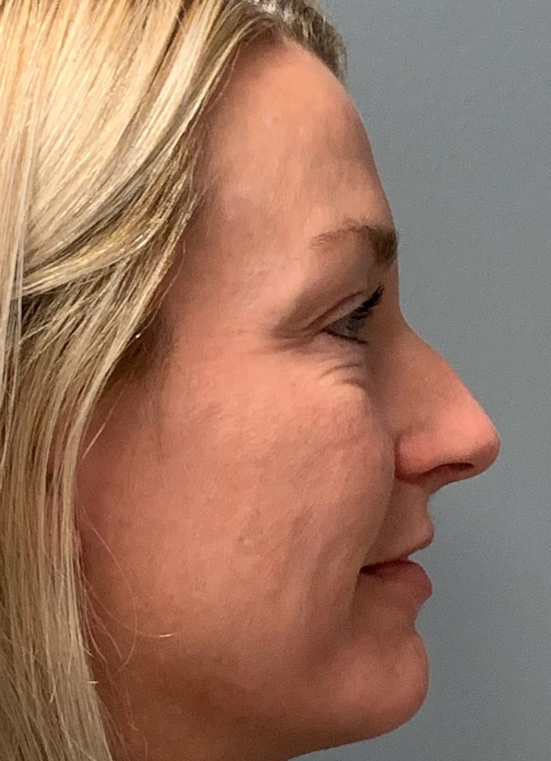 Blepharoplasty Before & After Gallery - Patient 387357 - Image 5