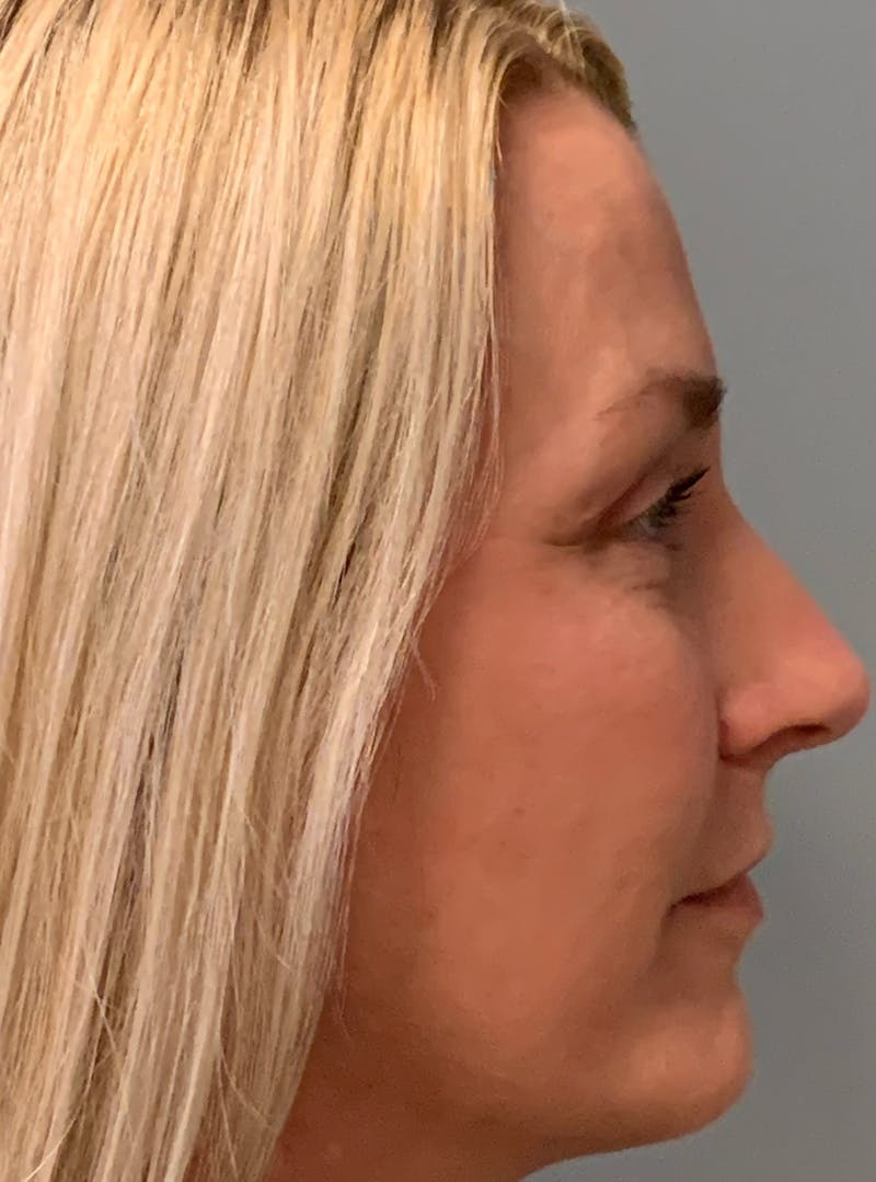 Blepharoplasty Before & After Gallery - Patient 387357 - Image 6