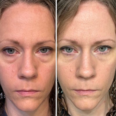 Blepharoplasty Before & After Gallery - Patient 343617 - Image 1