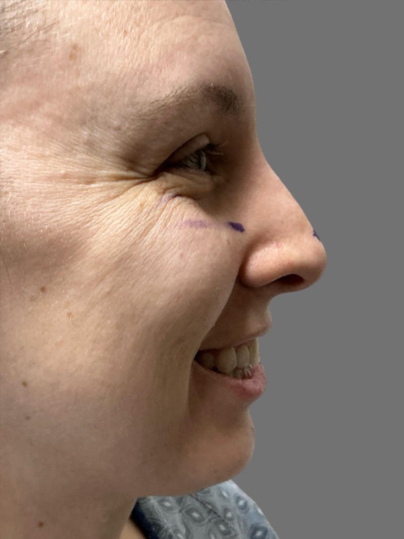 Chin Augmentation Before & After Gallery - Patient 125632 - Image 1