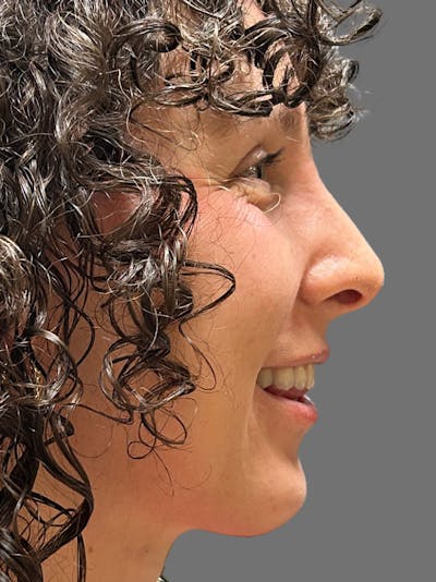 Chin Augmentation Before & After Gallery - Patient 125632 - Image 2
