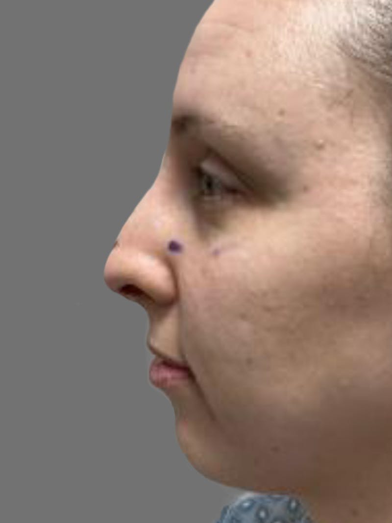 Chin Augmentation Before & After Gallery - Patient 125632 - Image 5