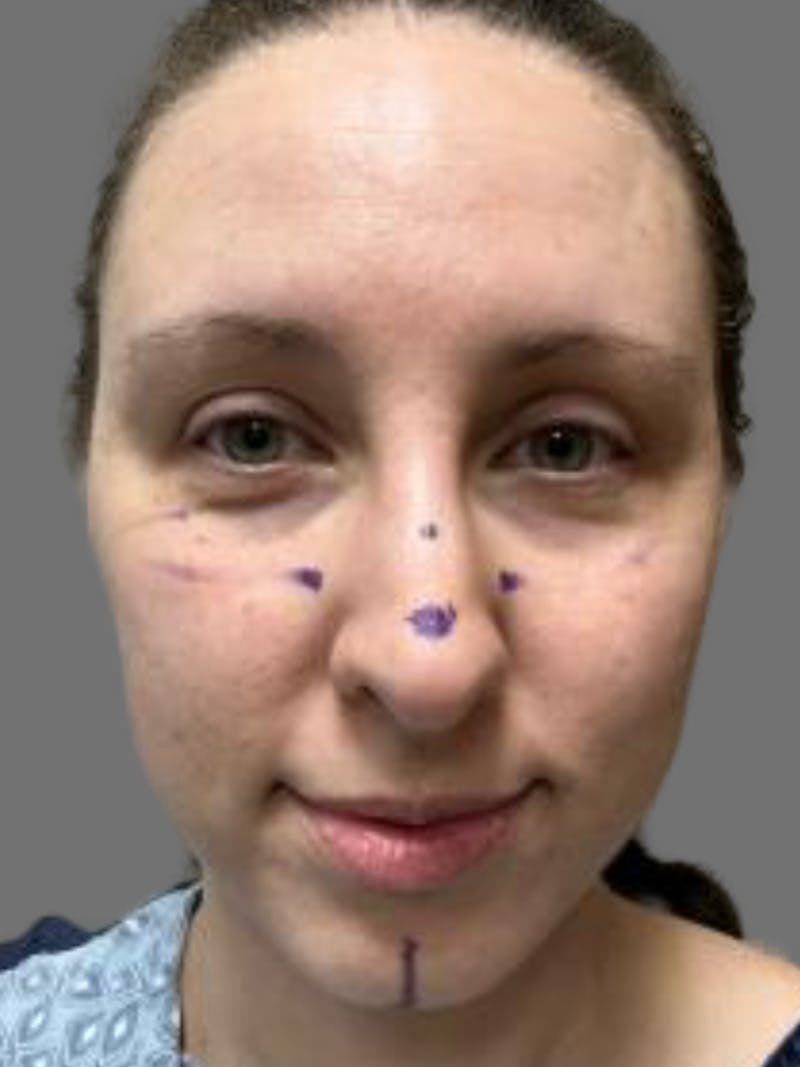 Chin Augmentation Before & After Gallery - Patient 125632 - Image 3