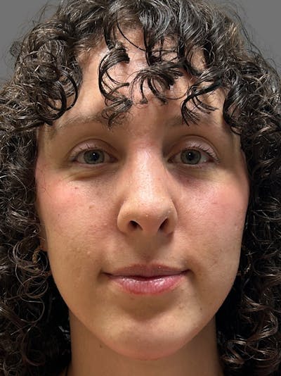 Rhinoplasty Before & After Gallery - Patient 158950 - Image 2