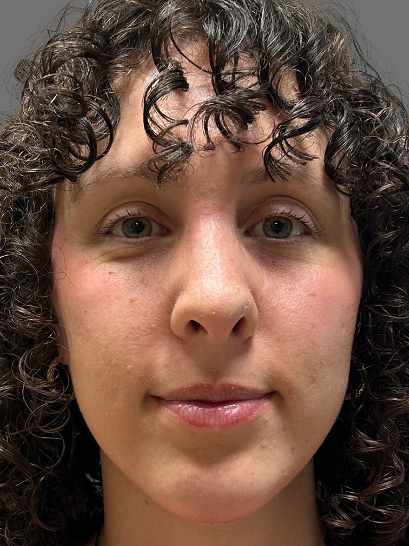 Chin Augmentation Before & After Gallery - Patient 125632 - Image 4