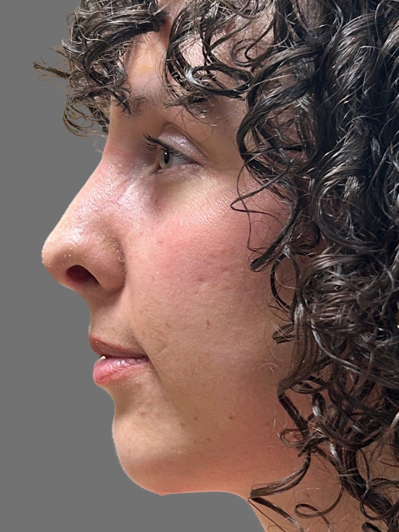 Chin Augmentation Before & After Gallery - Patient 125632 - Image 6