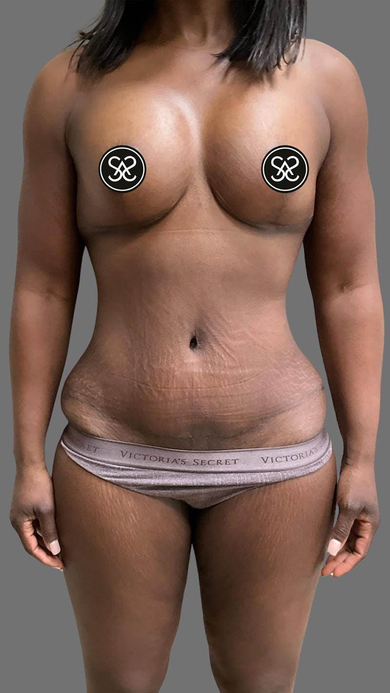 High Definition Mommy Makeover Before & After Gallery - Patient 385424 - Image 2