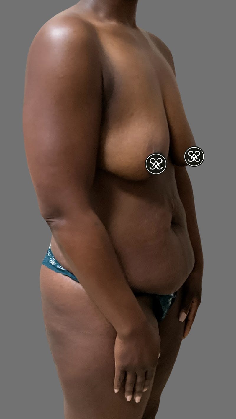 High Definition Mommy Makeover Before & After Gallery - Patient 385424 - Image 3