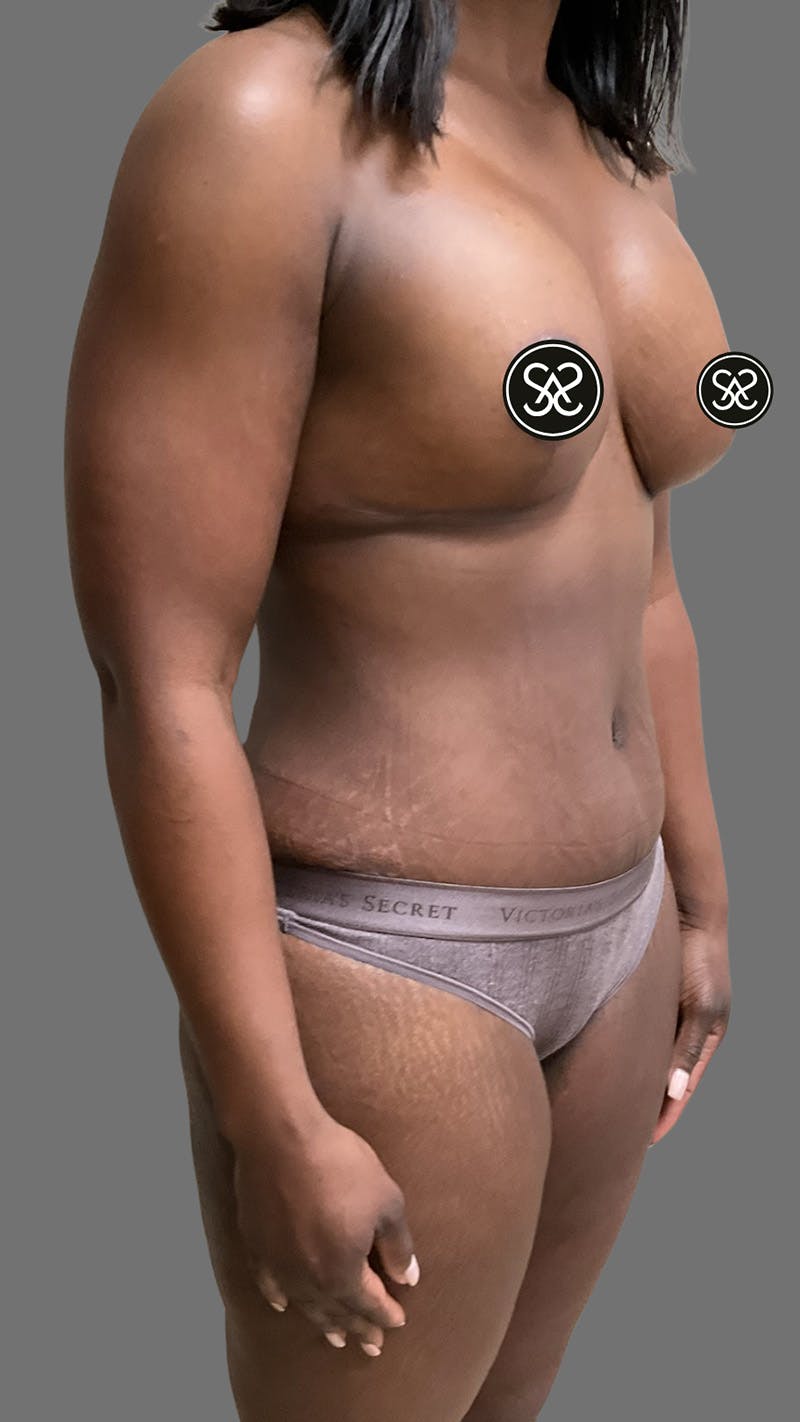 High Definition Mommy Makeover Before & After Gallery - Patient 385424 - Image 4