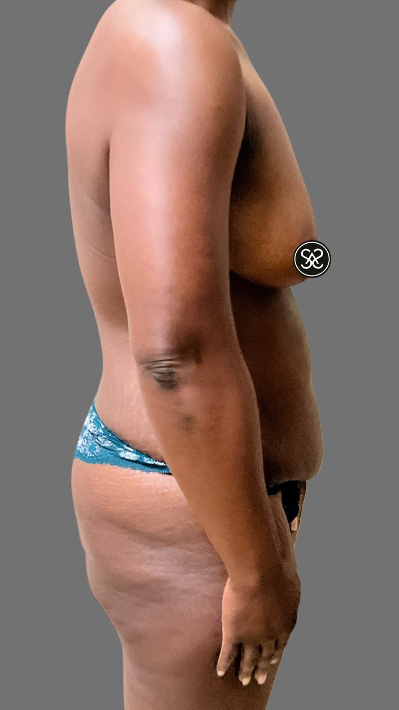 High Definition Mommy Makeover Before & After Gallery - Patient 385424 - Image 5