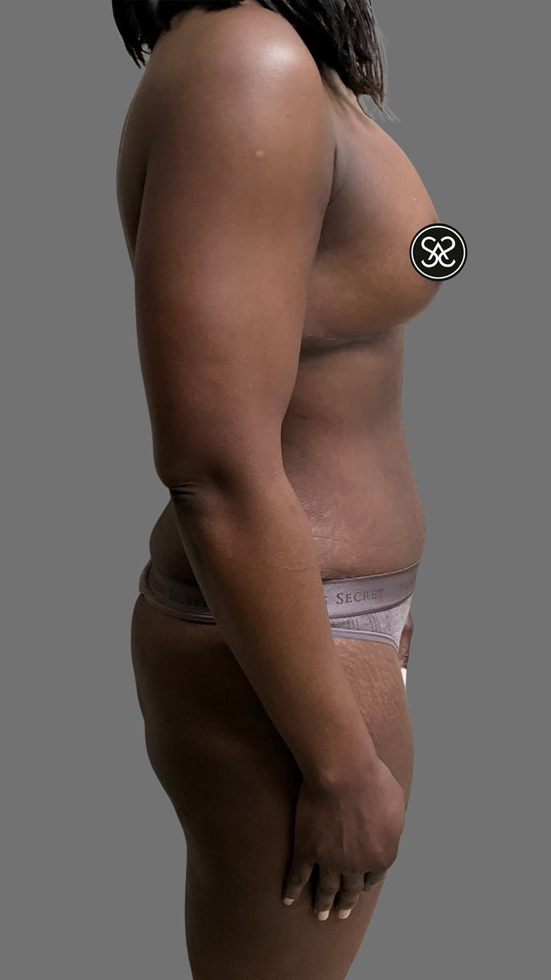 High Definition Mommy Makeover Before & After Gallery - Patient 385424 - Image 6