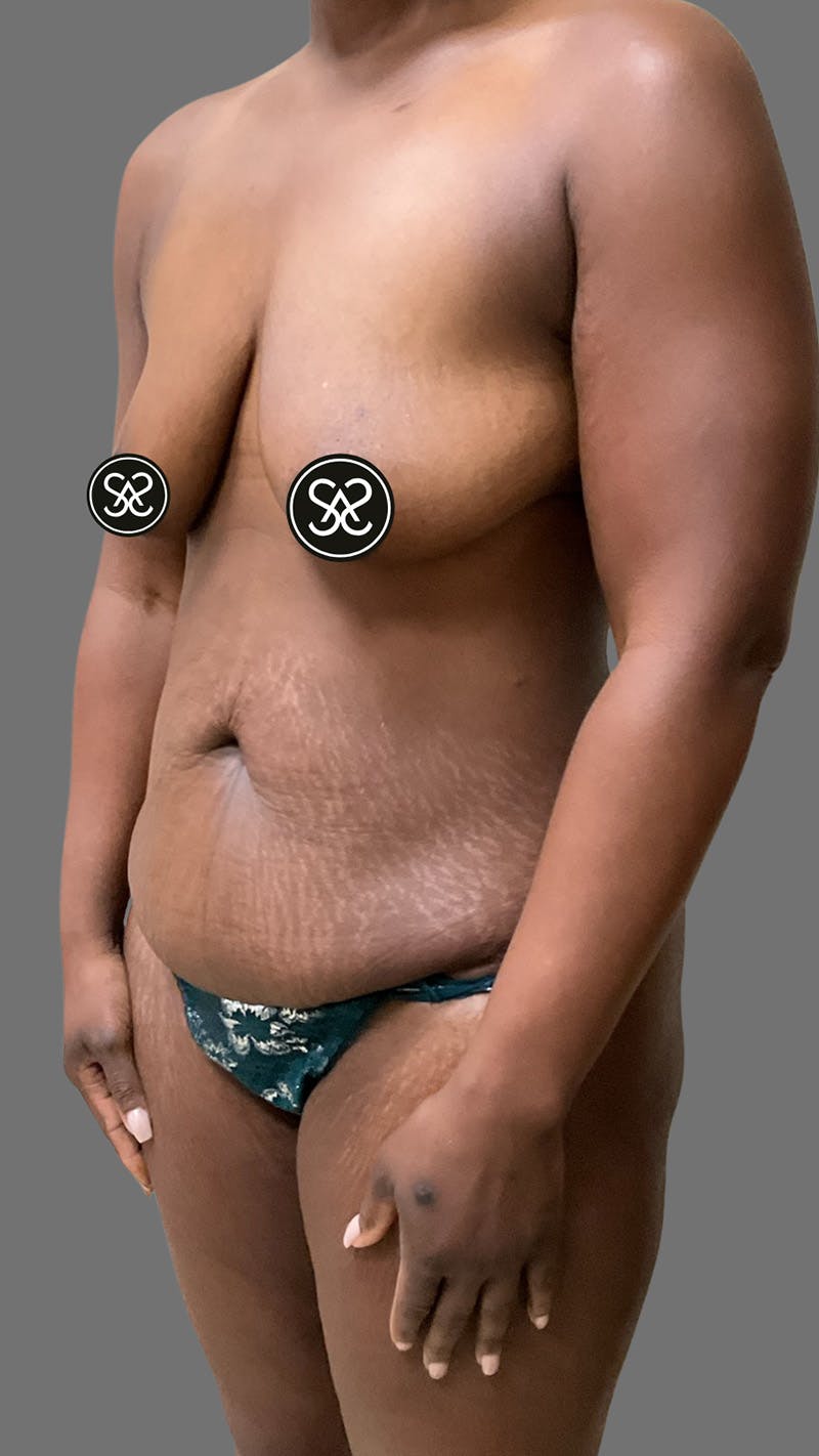 High Definition Mommy Makeover Before & After Gallery - Patient 385424 - Image 7