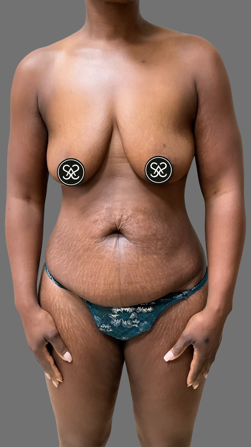 High Definition Mommy Makeover Before & After Gallery - Patient 385424 - Image 1