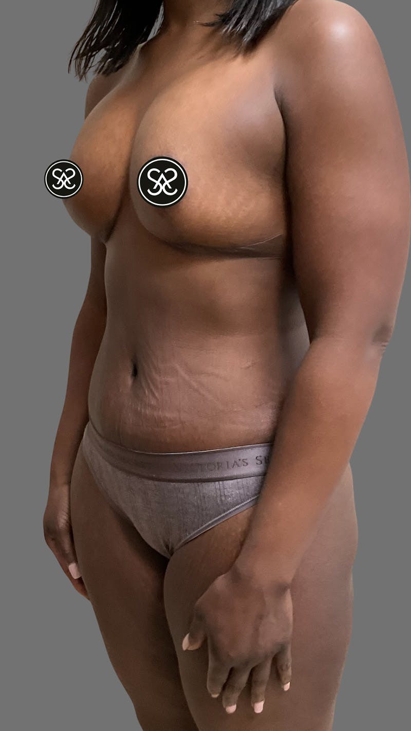 High Definition Mommy Makeover Before & After Gallery - Patient 385424 - Image 8