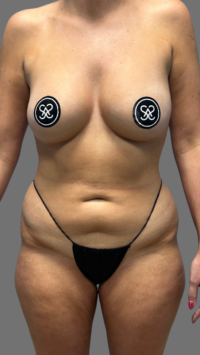 Liposuction Before & After Gallery - Patient 374541 - Image 1
