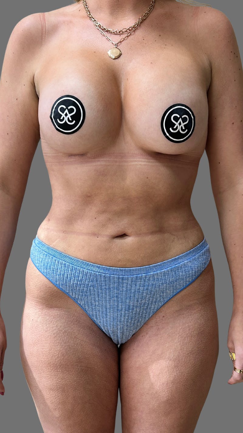 Liposuction Before & After Gallery - Patient 374541 - Image 2