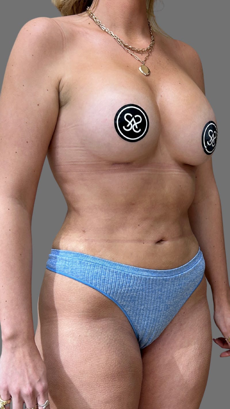 Liposuction Before & After Gallery - Patient 374541 - Image 4