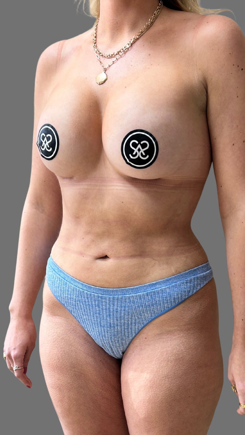 Liposuction Before & After Gallery - Patient 374541 - Image 6