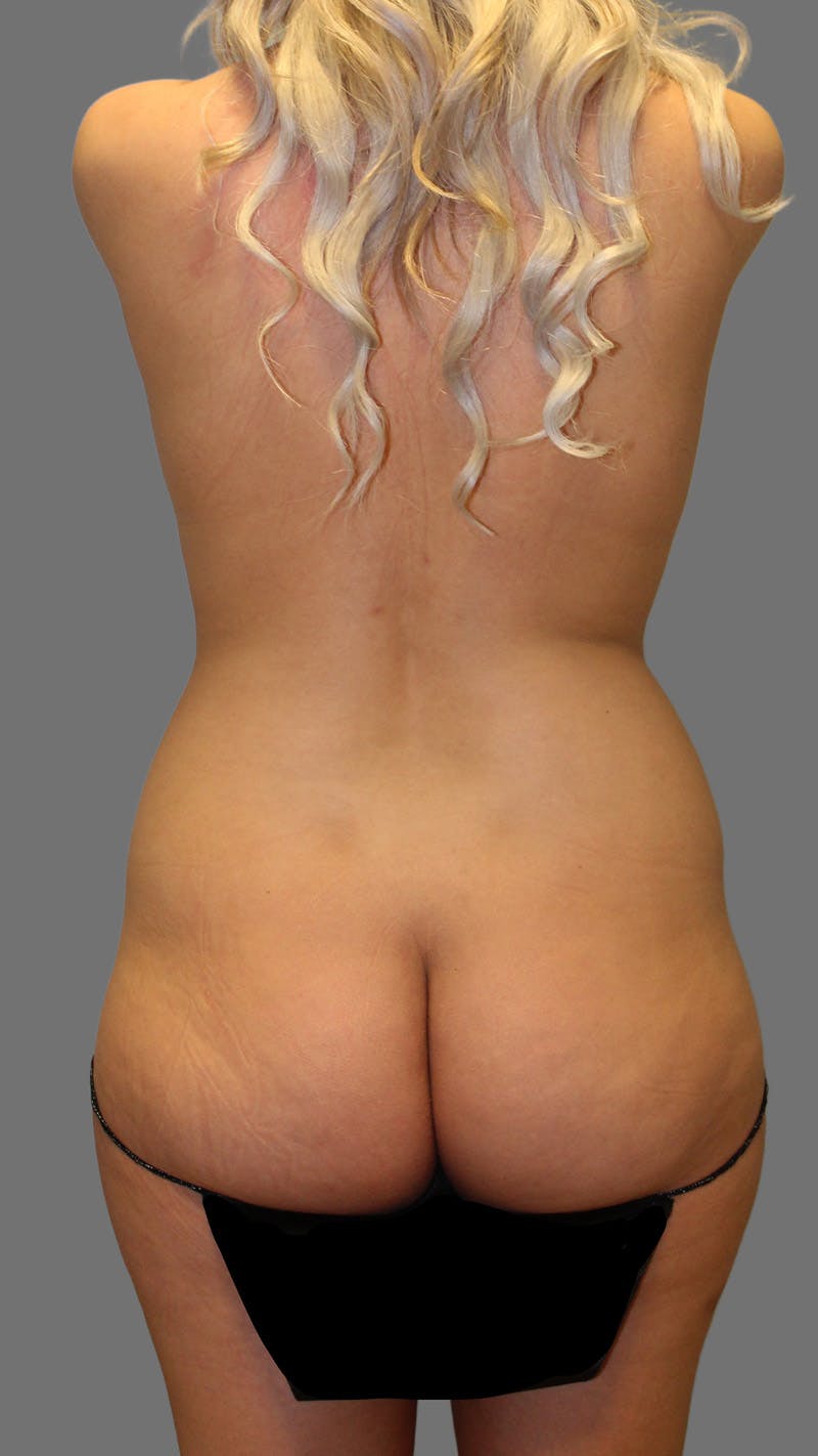 Brazilian Butt Lift Before & After Gallery - Patient 256941 - Image 1