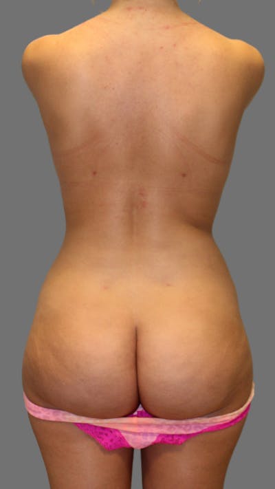 Brazilian Butt Lift Before & After Gallery - Patient 256941 - Image 2