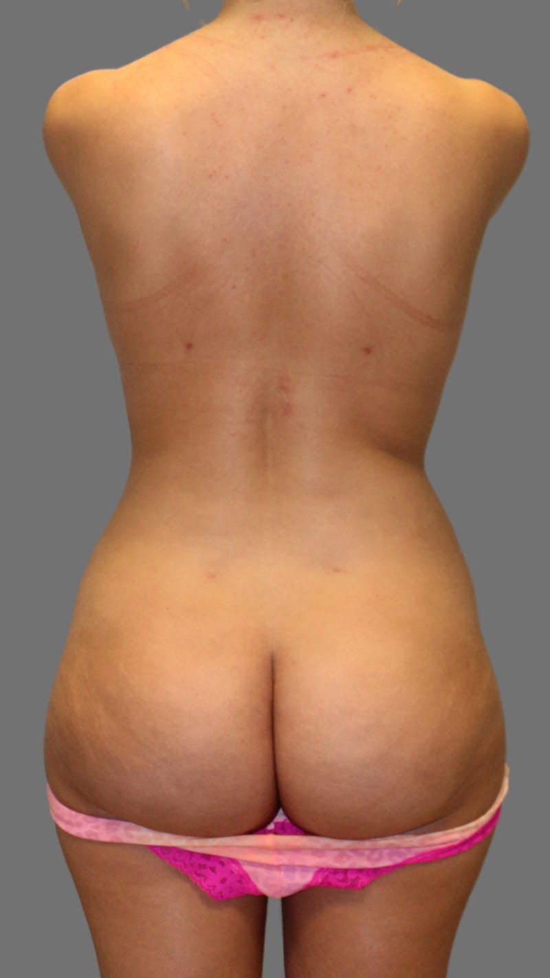 Brazilian Butt Lift Before & After Gallery - Patient 256941 - Image 2
